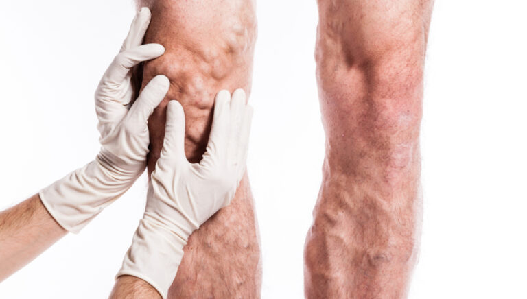 Importance-of-early-diagnosis-for-PAD-prevention